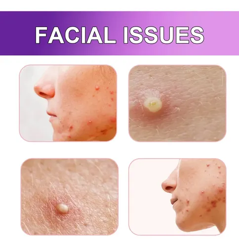 Acne Patches Space Edition Elimina Granitos, 180 Unidades