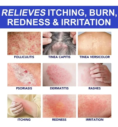 Crema Tratamiento 1% Ácido Salicílico Para Foliculitis