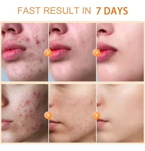 Crema Antiacné Facial 30 Ml