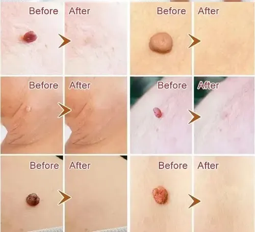 Loción Eliminadora De Verrugas Para Cara, Cuello Y Genitales