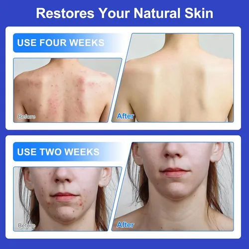 Crema Tratamiento 1% Ácido Salicílico Para Foliculitis