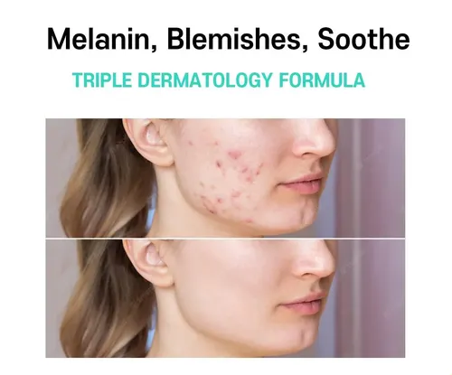 Tt Melasma, Manchas Oscuras, Aclarar, Unificar Tono Ww