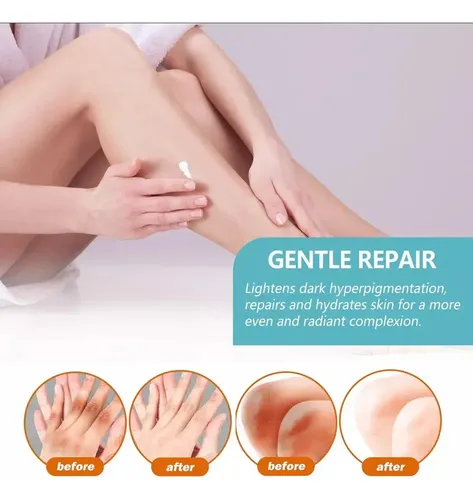 Hd Fixderma Nigrifix Crema Para Acantosis Nigricans Fbg,h