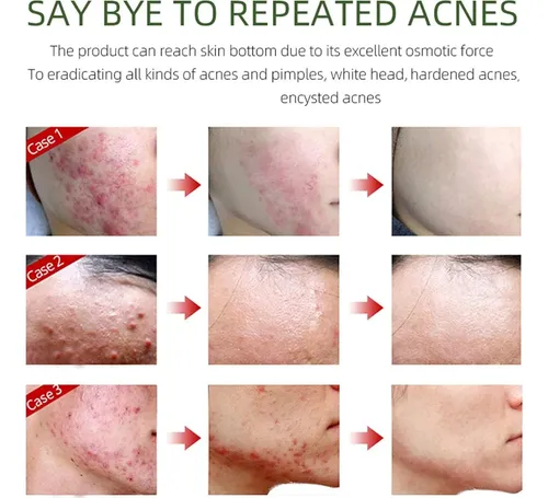 Crema Antiacné Herbal Whhwm