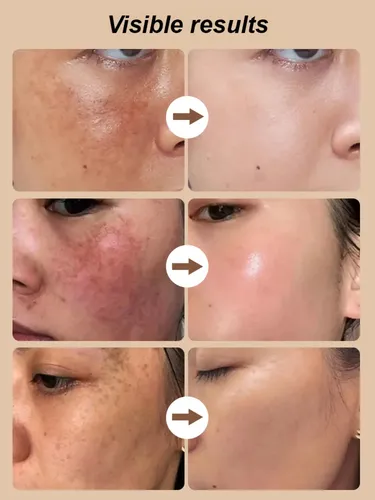 Tratamiento Hidratante Y Reparador Para Manchas, 4 Botellas