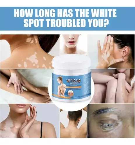 A5080301 Pmpara Crema Para Vitíligo, Elimina Las Manchas