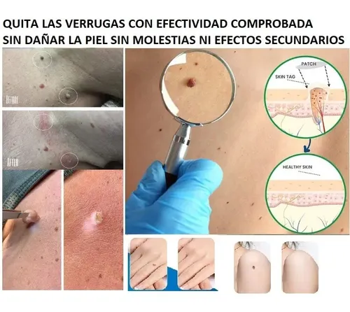 Loción Eliminadora De Verrugas Para Cara, Cuello Y Genitales