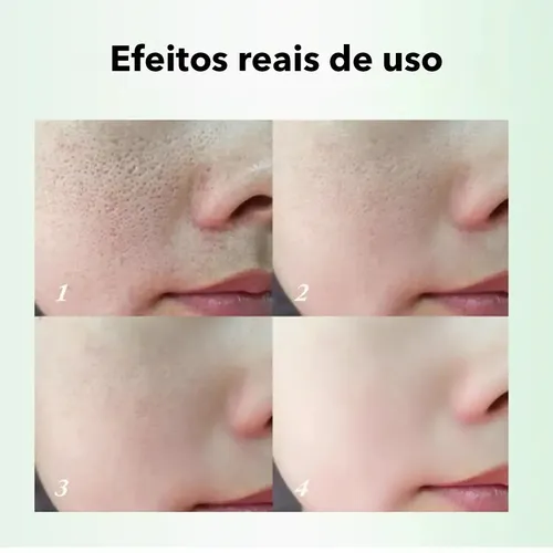 .sa Crema De Ácido Salicílico Z Para Eliminar Los Poros .hg