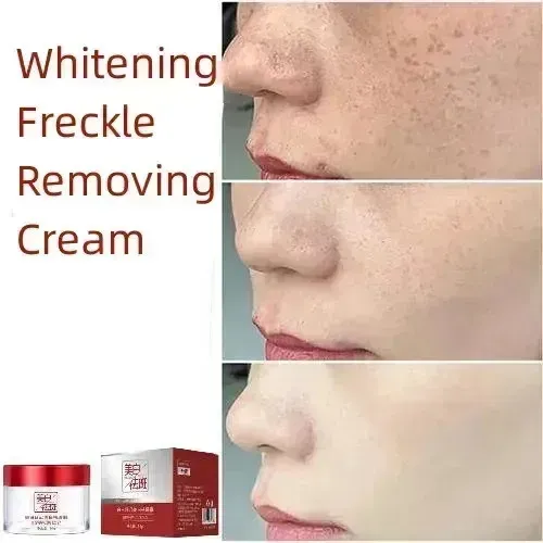 Whcrema Blanqueadora Para Eliminar Manchas Oscuras Xt *++wq