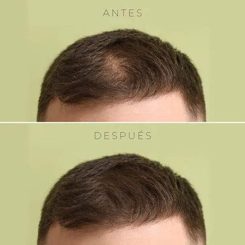 Repuesto Fibras Capilares Beauty Choice Negro 100g Calvicie Pelo Recarga