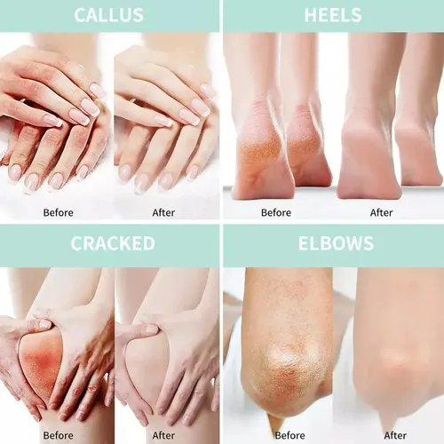 Lm Xf ^ – Crema De Urea Al 40 Por Ciento For Los Pies Más