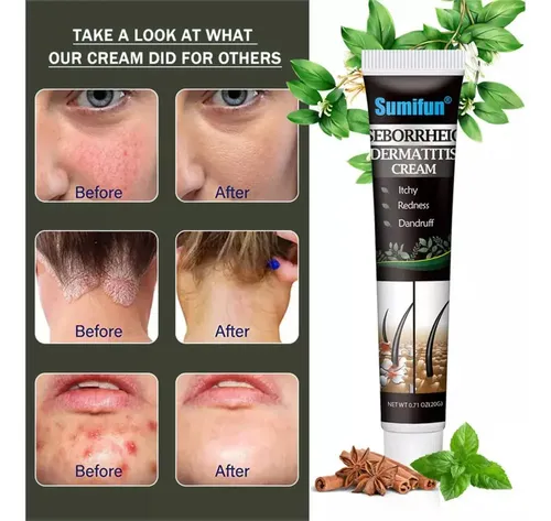 2 Piezas De Crema For La Dermatitis Seborreica .