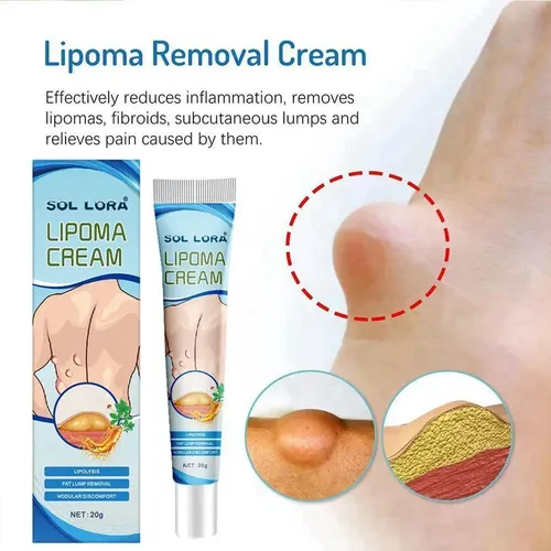 Crema Eliminación De Lipomas 20g2 Unidades –
