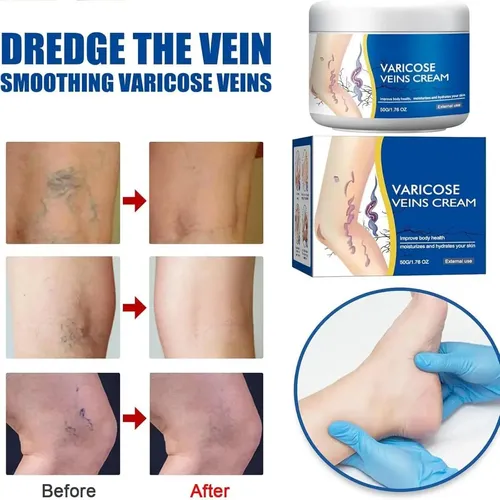 D Crema Reparadora De Piernas Para Venas Varicosas, Crema