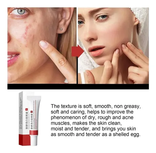 +crema Para Manchas Oscuras En La Cara, Cremas Para Quitar /