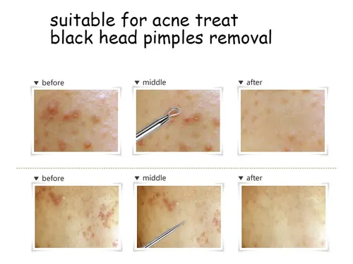 Juego De 1 Unidad, Blackhead Needles Ii, Eliminador De Comed