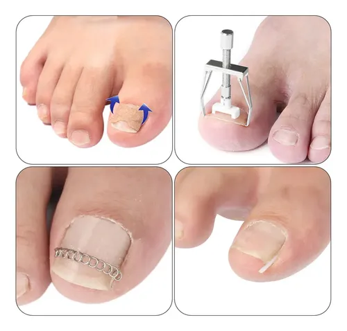Set De Tratamiento Corrector De Uñas Encarnadas De Acero Ino