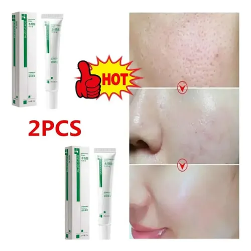 Salicylic Acid Cream Reduces Facial Pores