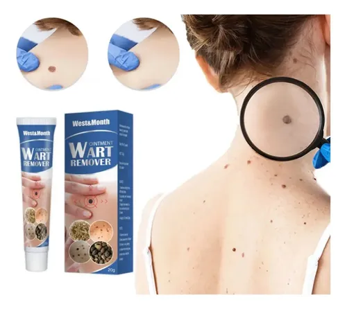 Sd4 Crema For Eliminar El Acné A Base De Wart Remover