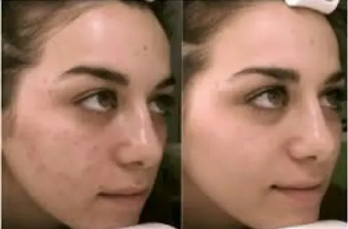 SEBUM CONTROL TREATMENT Idraet Dermopurity