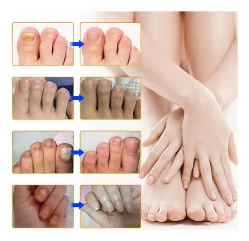 +parches Para Hongos En Las Uñas De Los Pies (3 Piezas).