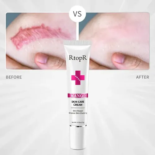 Crema Para Cicatrices Manchas Quemaduras Estrias Acne New!